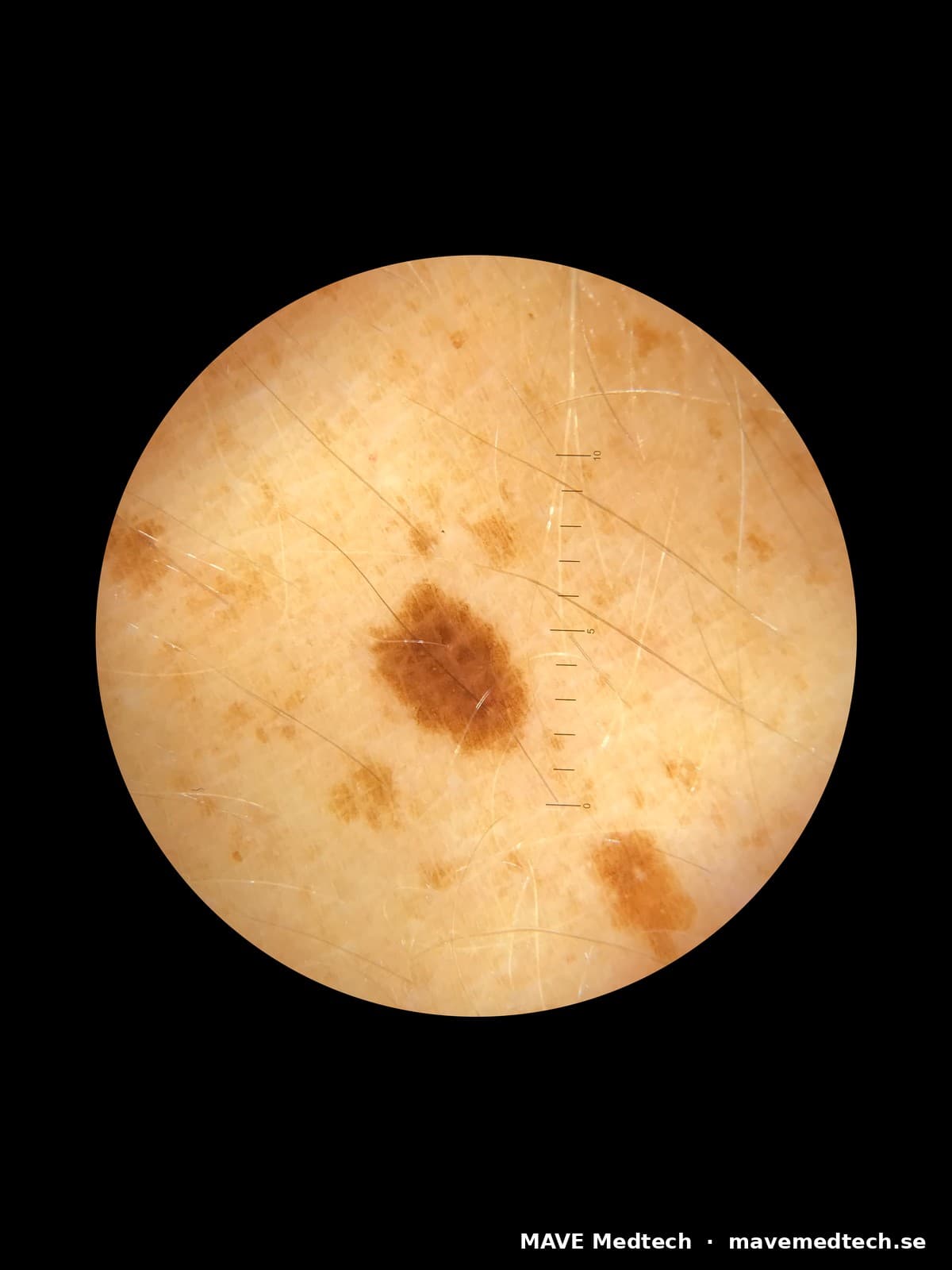Vilken mobil och app ger bäst dermatoskopbilder? Vårt test